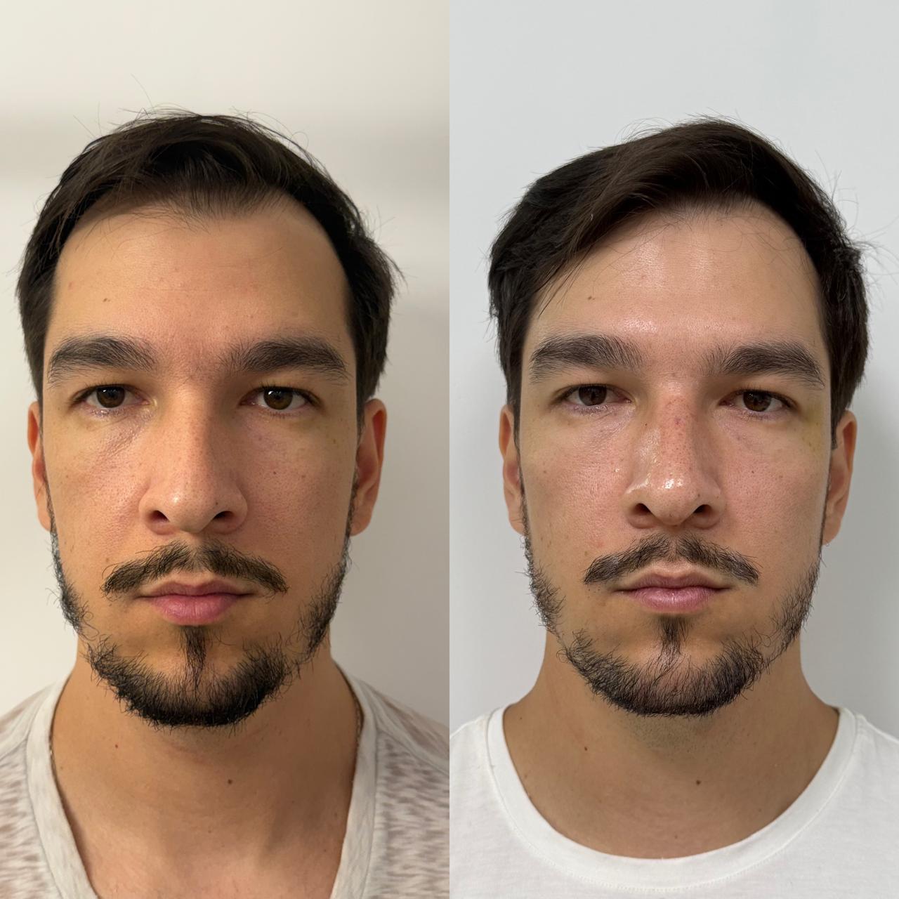 Mandíbula e mento em rosto masculino, antes e depois do Full Face.