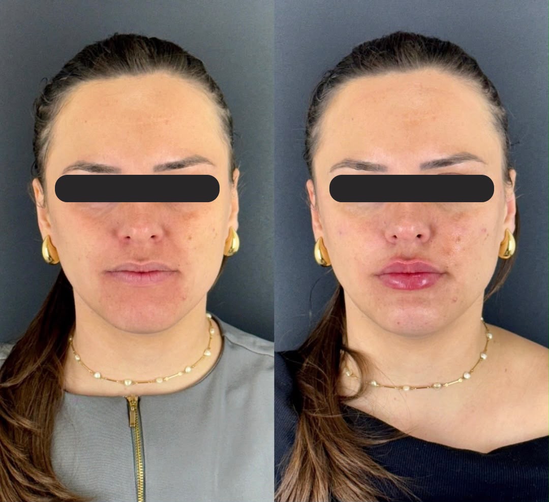 Terço inferior de frente: mento e mandíbula sustentando o contorno, antes e depois.