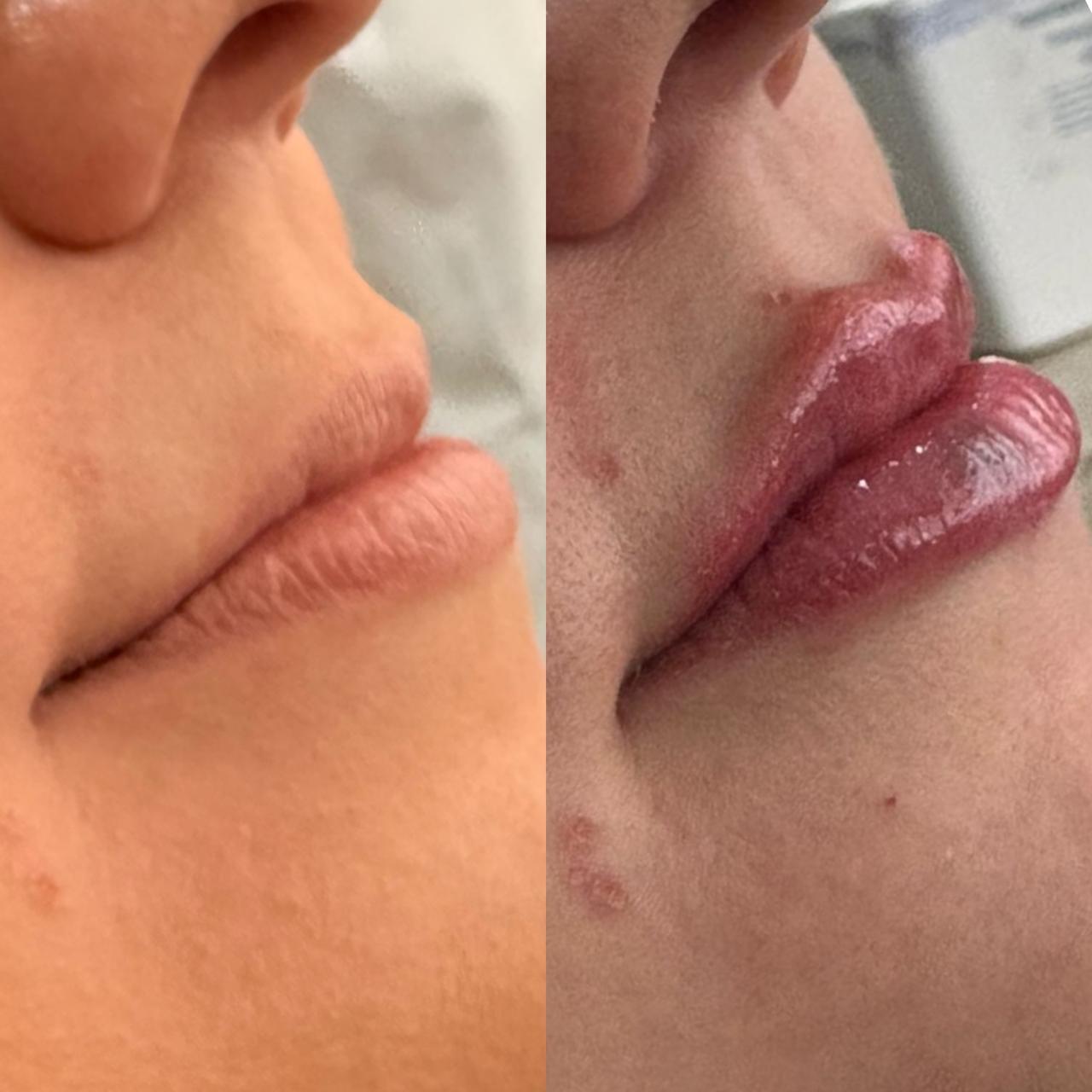 Detalhe de contorno labial após preenchimento.