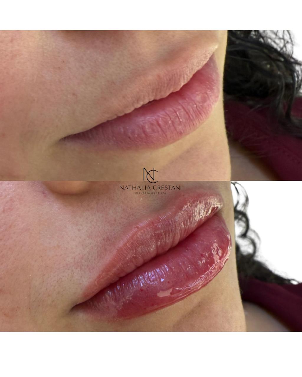 Contorno e proporção entre lábio superior e inferior, antes e depois do preenchimento labial.