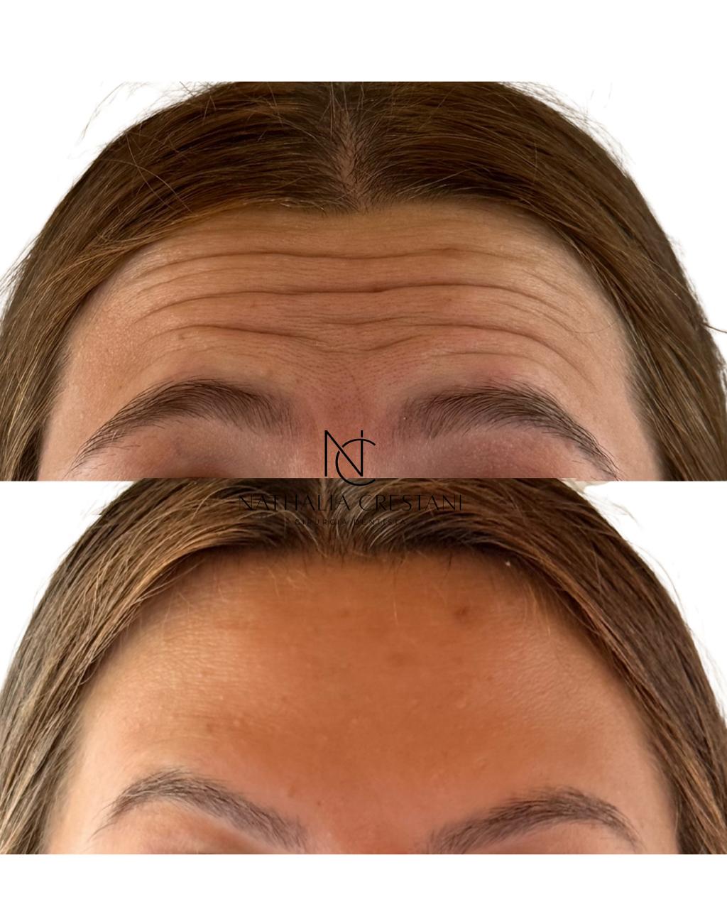 Comparação de linhas de expressão antes e depois da toxina botulínica.