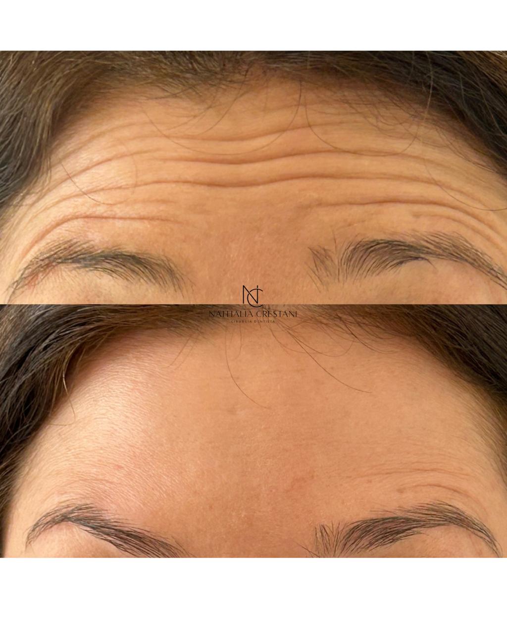 Linhas de testa em repouso, antes e depois da toxina botulínica.
